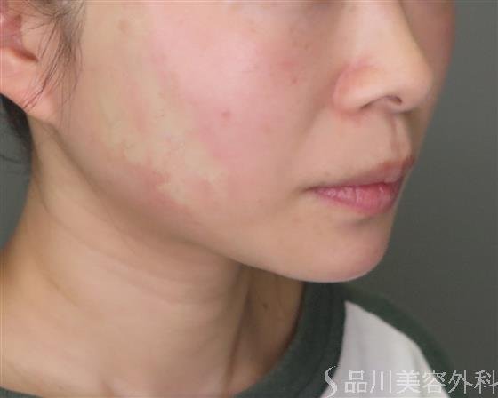 症例NO.47962のAFTER写真
