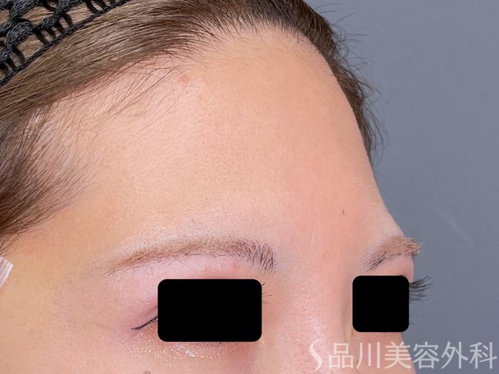 症例NO.74780のBEFORE写真