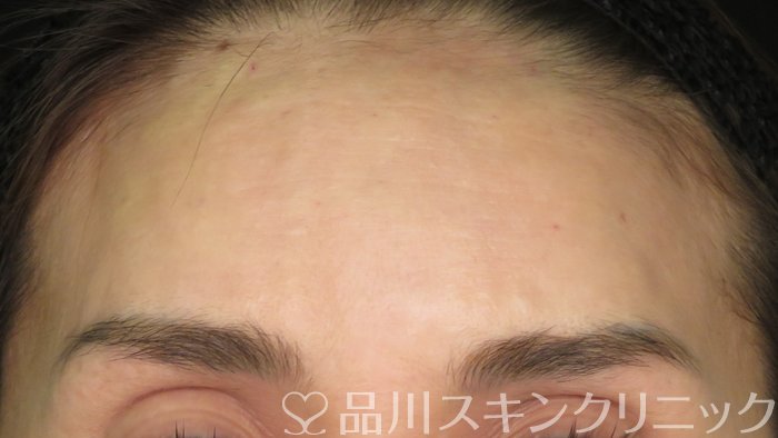 症例NO.71611のAFTER写真