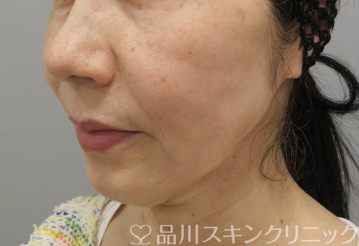 症例NO.70086のAFTER写真