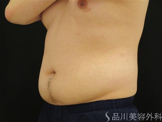 症例NO.51291のAFTER写真
