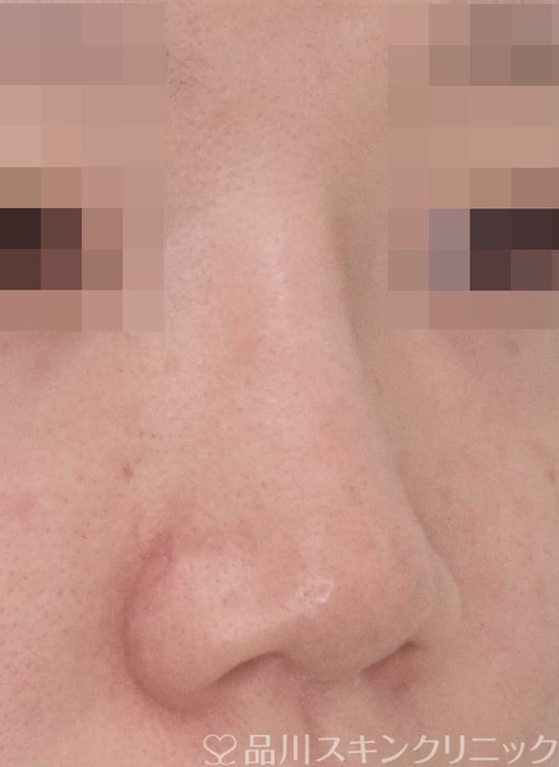 症例NO.67652のBEFORE写真