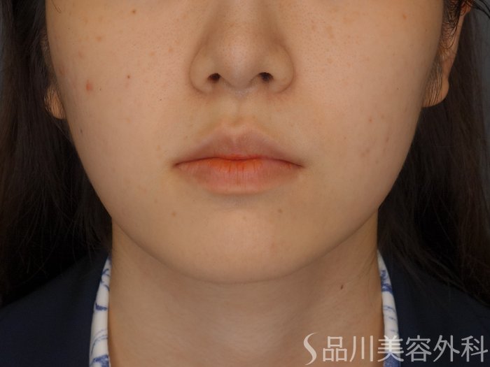 症例NO.71175のBEFORE写真