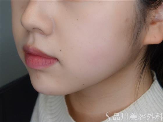 症例NO.51001のBEFORE写真