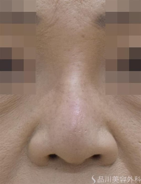 症例NO.51563のAFTER写真