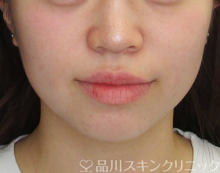 症例NO.74821のBEFORE写真