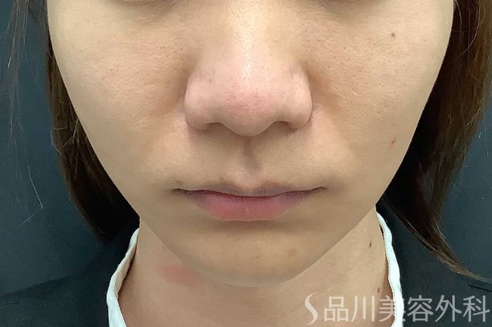 症例NO.63006のAFTER写真