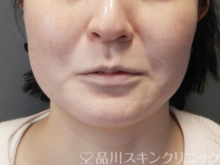 症例NO.73382のBEFORE写真