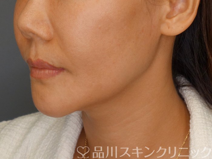 症例NO.71698のBEFORE写真