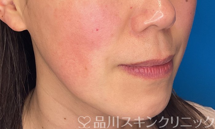 症例NO.74640のBEFORE写真
