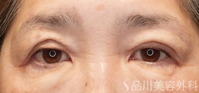 症例NO.72485のAFTER写真