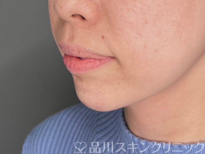 症例NO.69762のAFTER写真