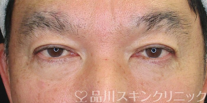 症例NO.73787のBEFORE写真