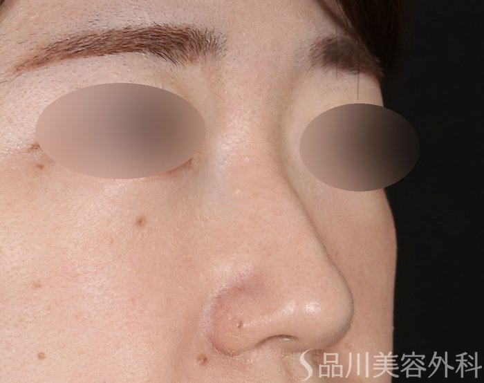 症例NO.71672のBEFORE写真