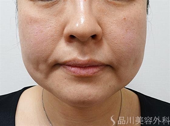 症例NO.55619のBEFORE写真