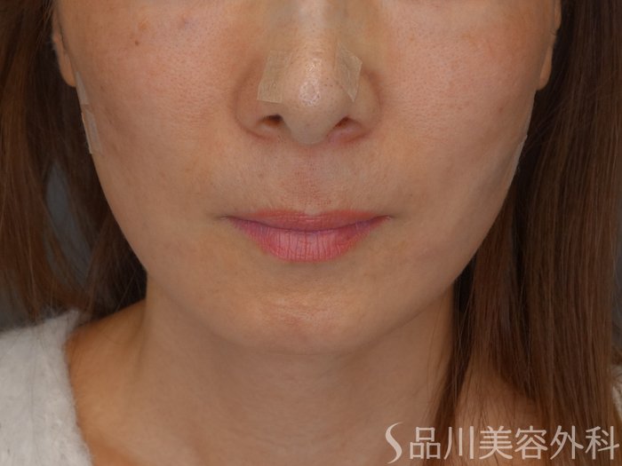 症例NO.72503のAFTER写真