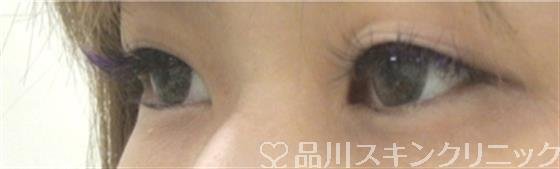 症例NO.30486のBEFORE写真