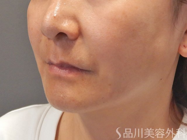 症例NO.72335のAFTER写真