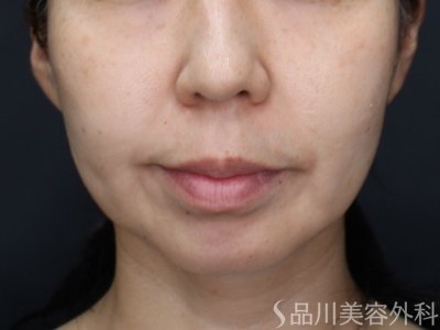症例NO.75123のBEFORE写真