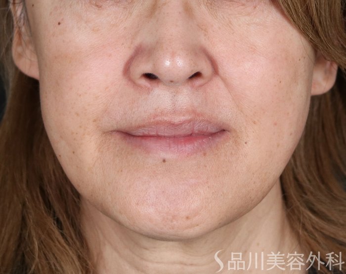 症例NO.72669のBEFORE写真