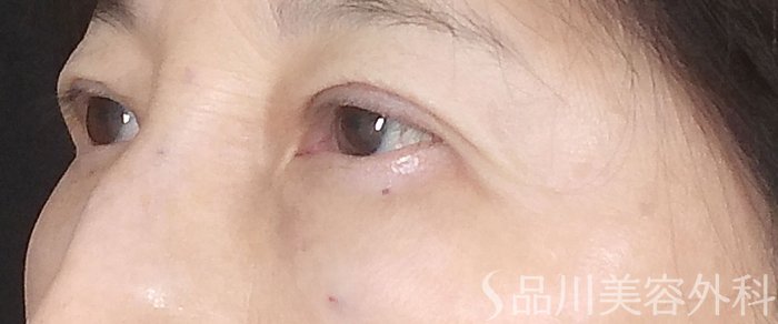 症例NO.73368のAFTER写真