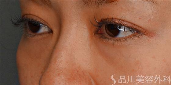 症例NO.58848のBEFORE写真