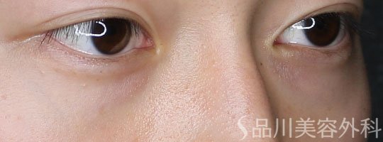 症例NO.74304のBEFORE写真