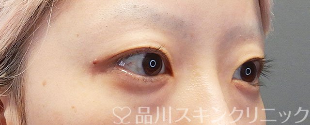 症例NO.72453のBEFORE写真