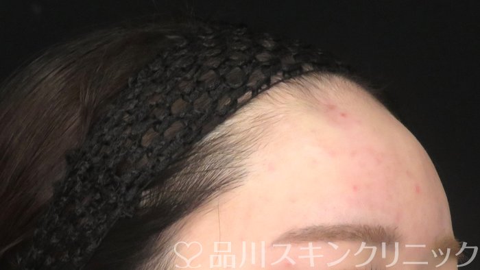 症例NO.71050のAFTER写真