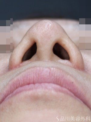 症例NO.74727のAFTER写真