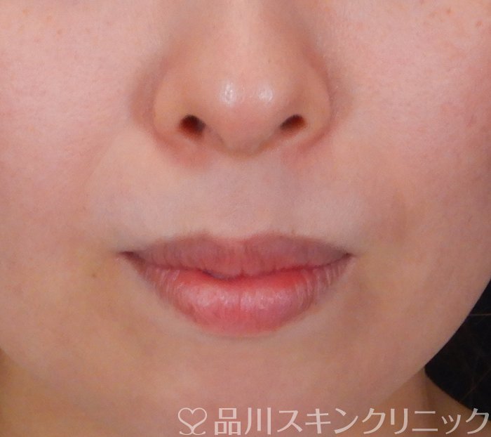 症例NO.66085のBEFORE写真