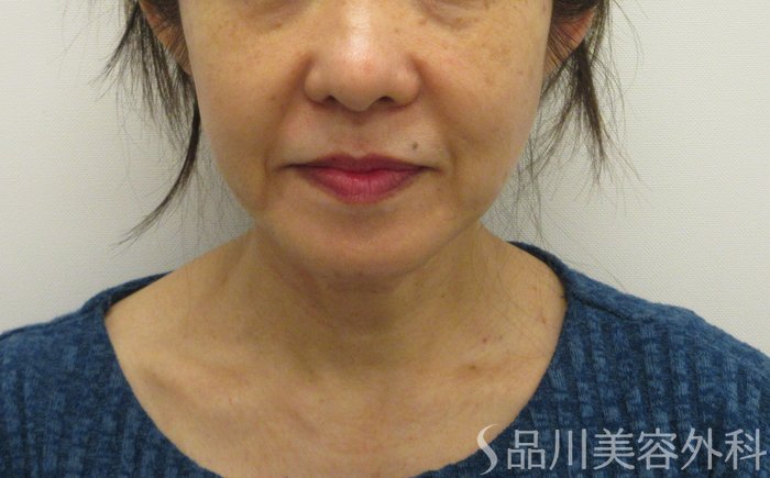 症例NO.73886のBEFORE写真