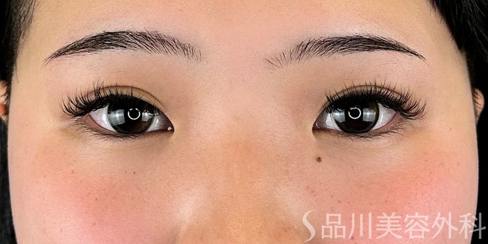症例NO.70778のBEFORE写真