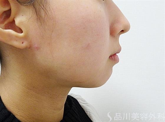症例NO.53255のBEFORE写真
