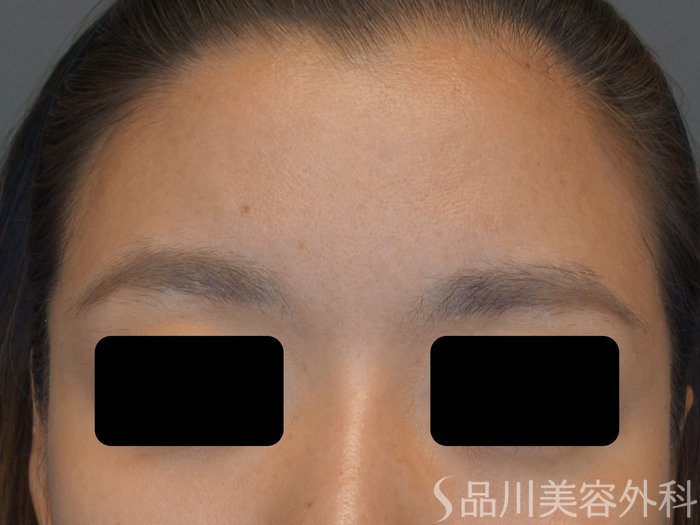 症例NO.74041のBEFORE写真