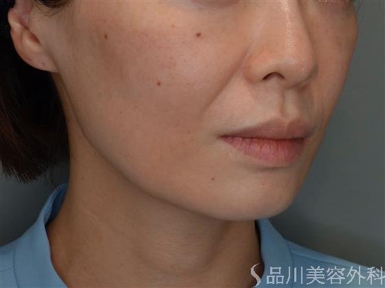 症例NO.51087のBEFORE写真
