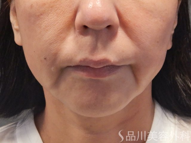 症例NO.72789のBEFORE写真