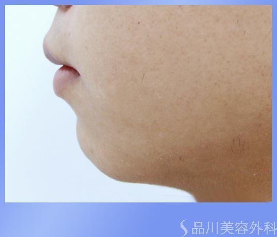 症例NO.1147のBEFORE写真