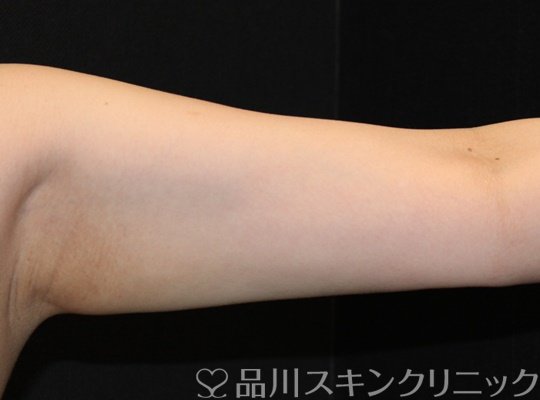 症例NO.71555のAFTER写真