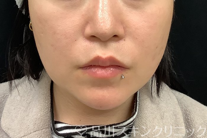 症例NO.69513のAFTER写真