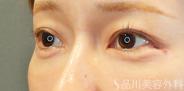 症例NO.67709のAFTER写真