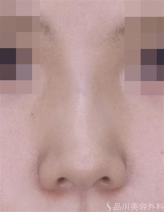 症例NO.50981のAFTER写真