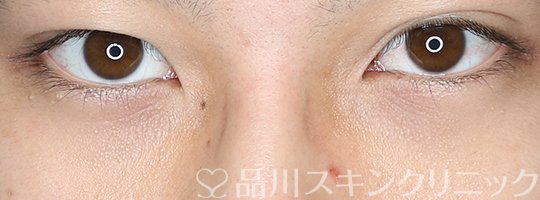 症例NO.70832のBEFORE写真