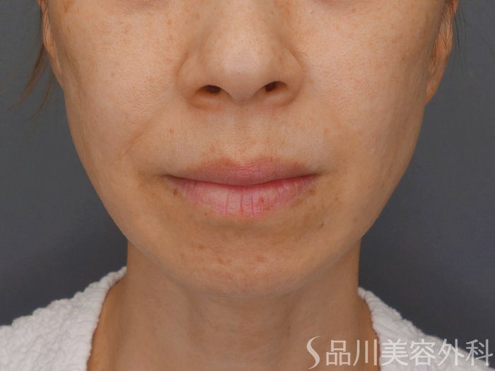 症例NO.71453のBEFORE写真