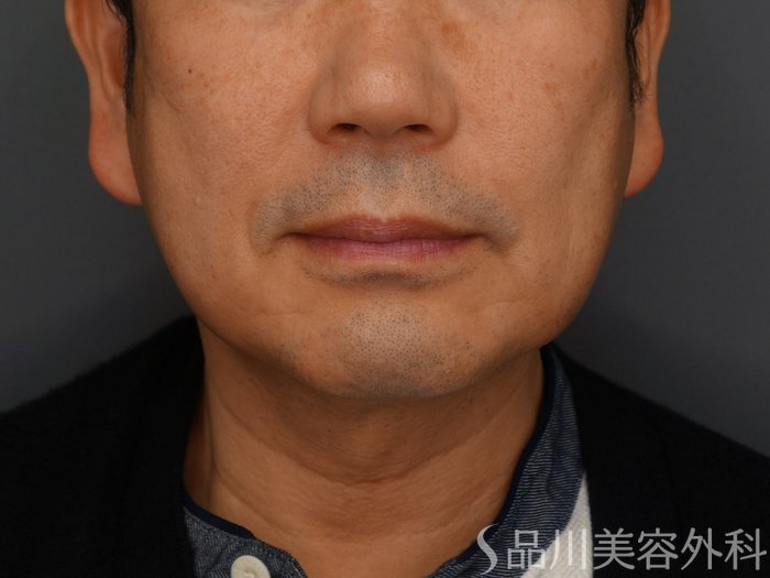 症例NO.74484のBEFORE写真