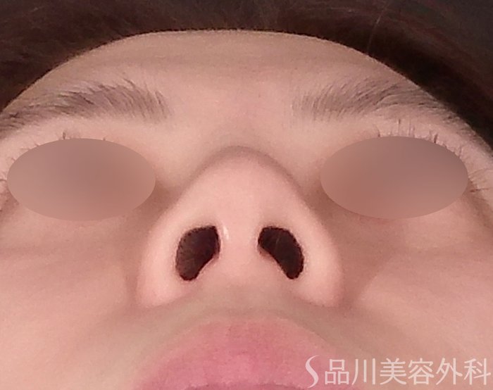 症例NO.71197のBEFORE写真