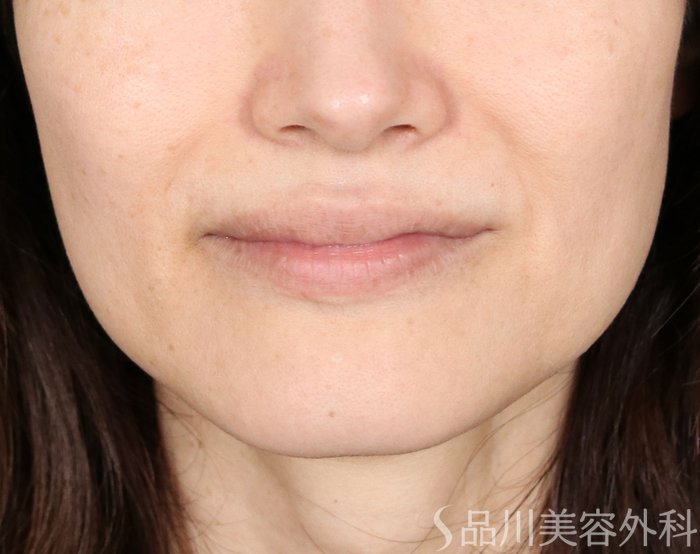 症例NO.70989のBEFORE写真
