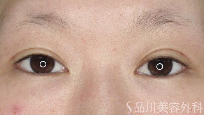 症例NO.65245のAFTER写真