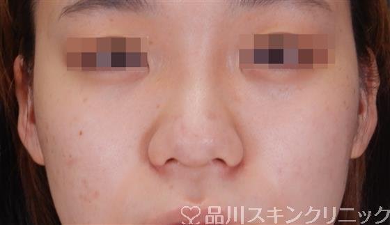 症例NO.56407のAFTER写真