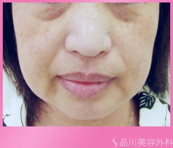 症例NO.1240のBEFORE写真